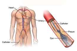 best angioplasty doctor in Kolkata