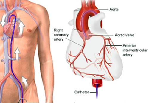 Coronary Angiography