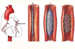 best angioplasty doctor in Kolkata